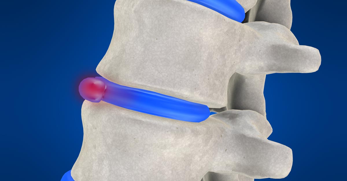 Humble non-surgical disc herniation treatment